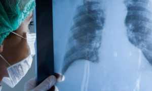 Метастазы при раке — причины возникновения и пути распространения