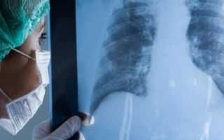 Метастазы при раке — причины возникновения и пути распространения