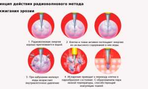 Симптомы, причины и лечение эрозии шейки матки