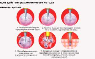 Симптомы, причины и лечение эрозии шейки матки