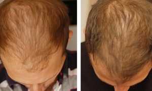 Мезотерапия для волос