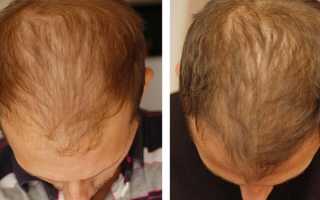 Мезотерапия для волос