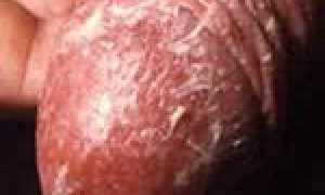 Методы диагностики и анализ на молочницу при кандидозе