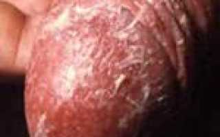 Методы диагностики и анализ на молочницу при кандидозе