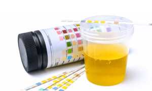 Сахар в моче — норма у мужчин и женщин, причины повышенных значений и как правильно сдавать анализ