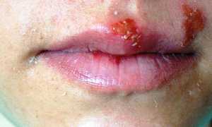 Первые признаки ВИЧ у мужчин — чувство тревоги и дезориентация, температура, лихорадочное состояние