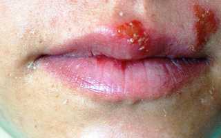 Первые признаки ВИЧ у мужчин — чувство тревоги и дезориентация, температура, лихорадочное состояние