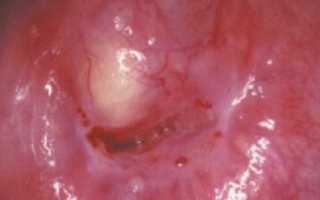 Какие бывают единичные кисты шейки матки?