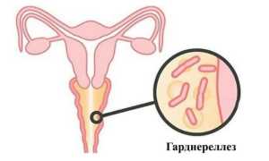 Схема лечения гарднереллеза у женщин — обзор эффективных препаратов
