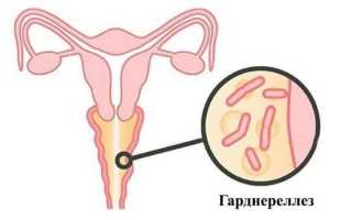 Схема лечения гарднереллеза у женщин — обзор эффективных препаратов