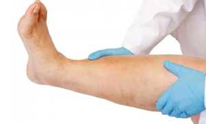 Отеки при сердечной недостаточности: причины и лечение