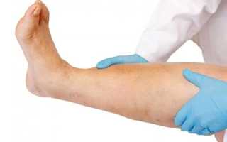 Отеки при сердечной недостаточности: причины и лечение