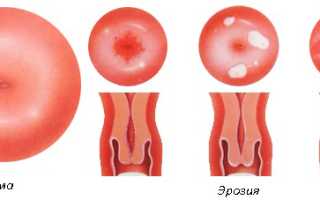 Может ли быть задержка месячных при эрозии шейки матки?