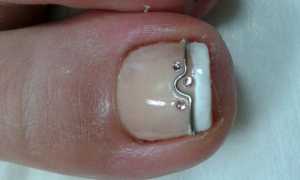 Вросший ноготь на большом пальце ноги