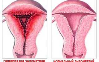Чем отличается гиперплазия эндометрия от аденомиоза?