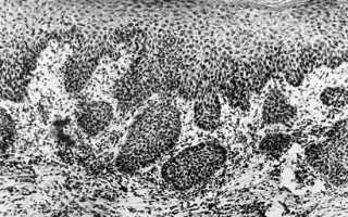 Акантоз шейки матки: что это такое, как проявляется, диагностика и лечение
