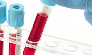 Что такое гепатит Б: симптомы и лечение