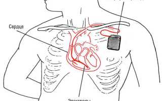 Кардиоверсия при мерцательной аритмии: как проводится, реабилитация и возможные осложнения