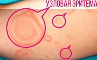 Эритема у детей и взрослых — причины, симптомы и лечение