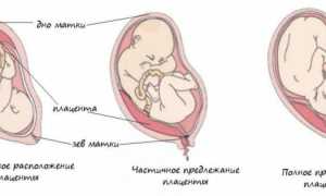 Низкая плацента при беременности