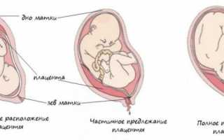 Низкая плацента при беременности