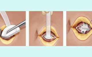 Удаление грыжи живота — как проводится операция