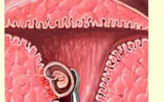 Как изменяется матка после аборта?