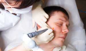 Как лечить папилломы