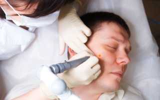 Как лечить папилломы