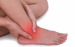 Лечение вывиха стопы в домашних условиях — препараты, народные методы