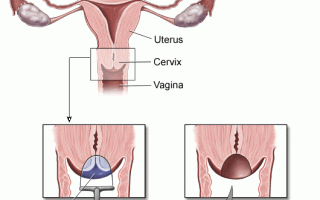 Какие подходы предполагает хирургическое лечение рака шейки матки?