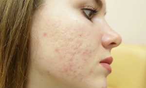 Как выдавить прыщ — правила и этапы процедуры в домашних условиях