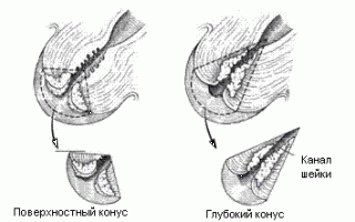Что такое радиоволновая конизация шейки матки?