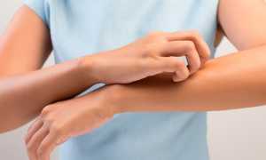 Эффективные средства против псориаза — мази на основе солидола