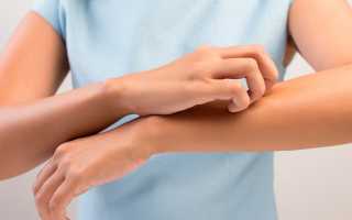 Эффективные средства против псориаза — мази на основе солидола