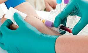 Анализ крови СА-125 при кисте яичника