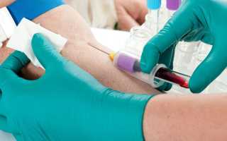 Анализ крови СА-125 при кисте яичника