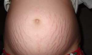 Масла от растяжек при беременности