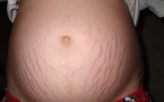 Масла от растяжек при беременности