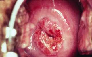 Как быстро развивается рак шейки матки: как не опоздать с лечением?