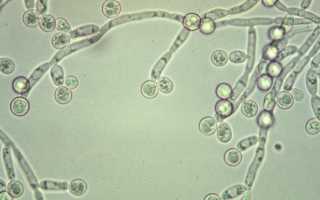 Лечение молочницы при беременности