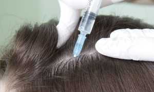 Выпадают волосы — что делать