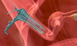 Больно ли делать ЭКО: отзывы, пункция и перенос