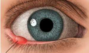 Ячмень – один из признаков снижения иммунитета при беременности