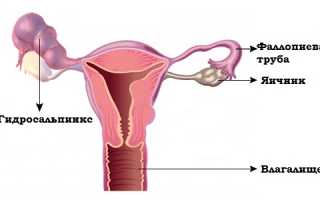 Почему собирается жидкость в маточных трубах?
