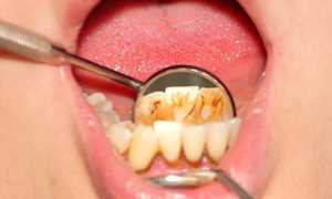 Металлический привкус во рту у женщин и мужчин — причины возникновения