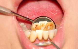 Металлический привкус во рту у женщин и мужчин — причины возникновения