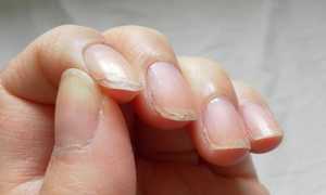 Слоятся ногти на руках у ребенка или взрослого — причины, методы лечения, процедуры в салоне и профилактика