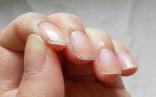 Слоятся ногти на руках у ребенка или взрослого — причины, методы лечения, процедуры в салоне и профилактика