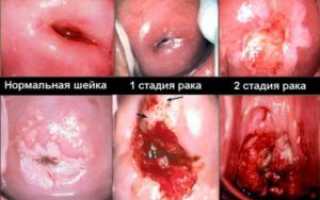 Чем грозит рак шейки матки 4 стадии?